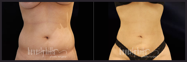 Before and after female liposuction (front)-1