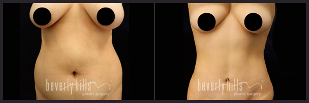 Before and after female liposuction (front)-3