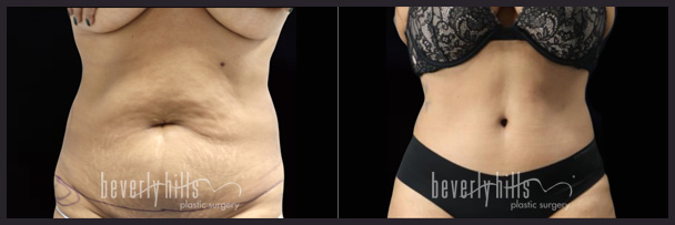 Before and after female liposuction (front)-2