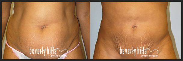 Tummy Liposuction Los Angeles  Abdomen Liposuction Beverly Hills