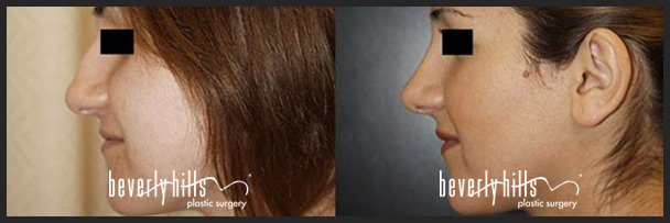 Before and after rhinoplasty (nose job) female example #1