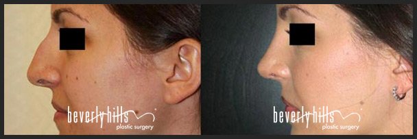 Before and after rhinoplasty (nose job) female-2