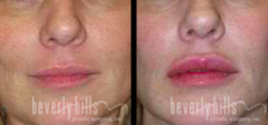 Juvederm Chiu Patient