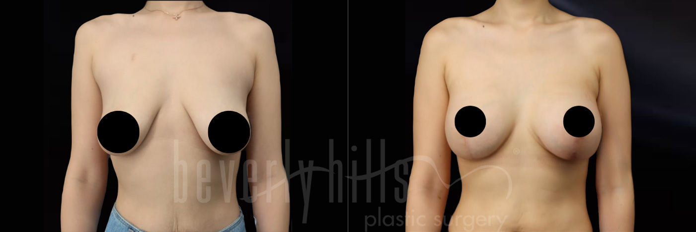 before and after breast lift-1