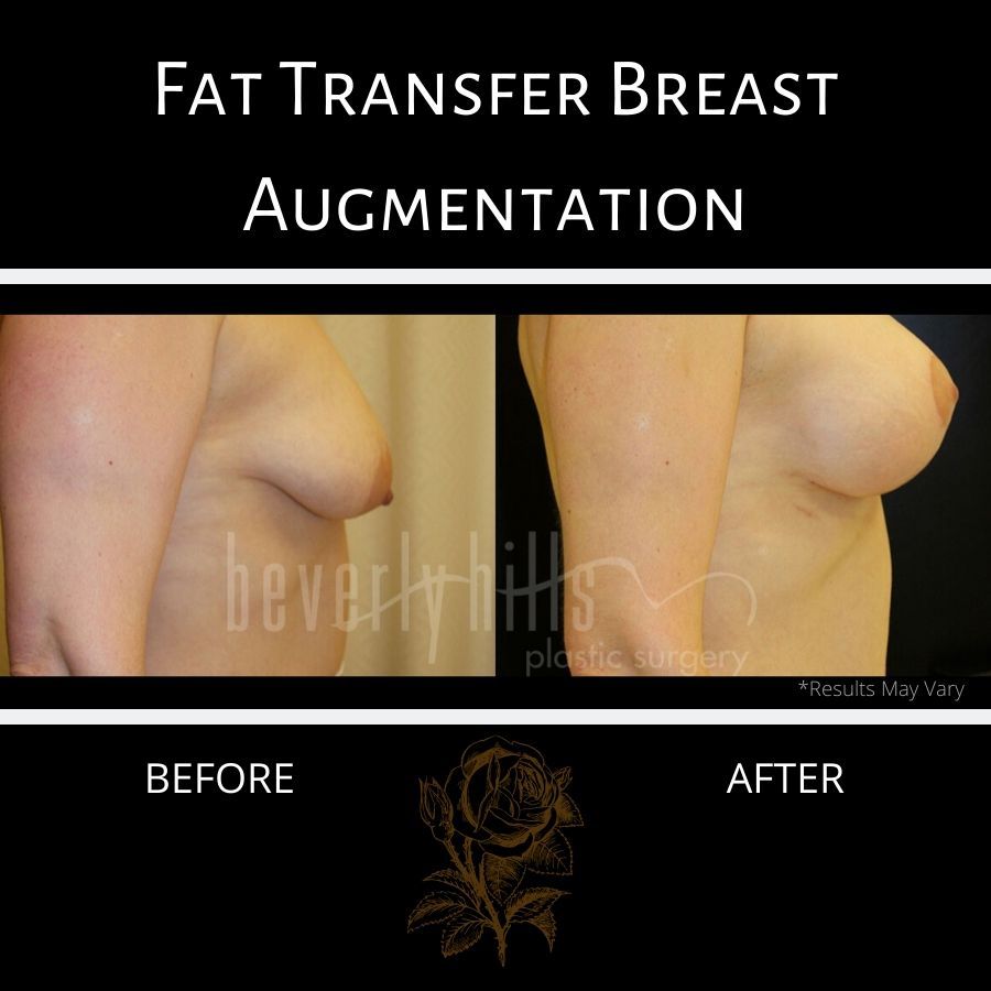 Natural Body Fat Transfer & Sculpting Procedures