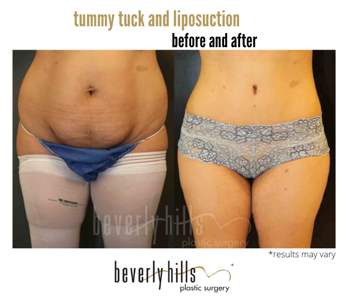 Best Tummy Tuck in Beverly Hills, CA