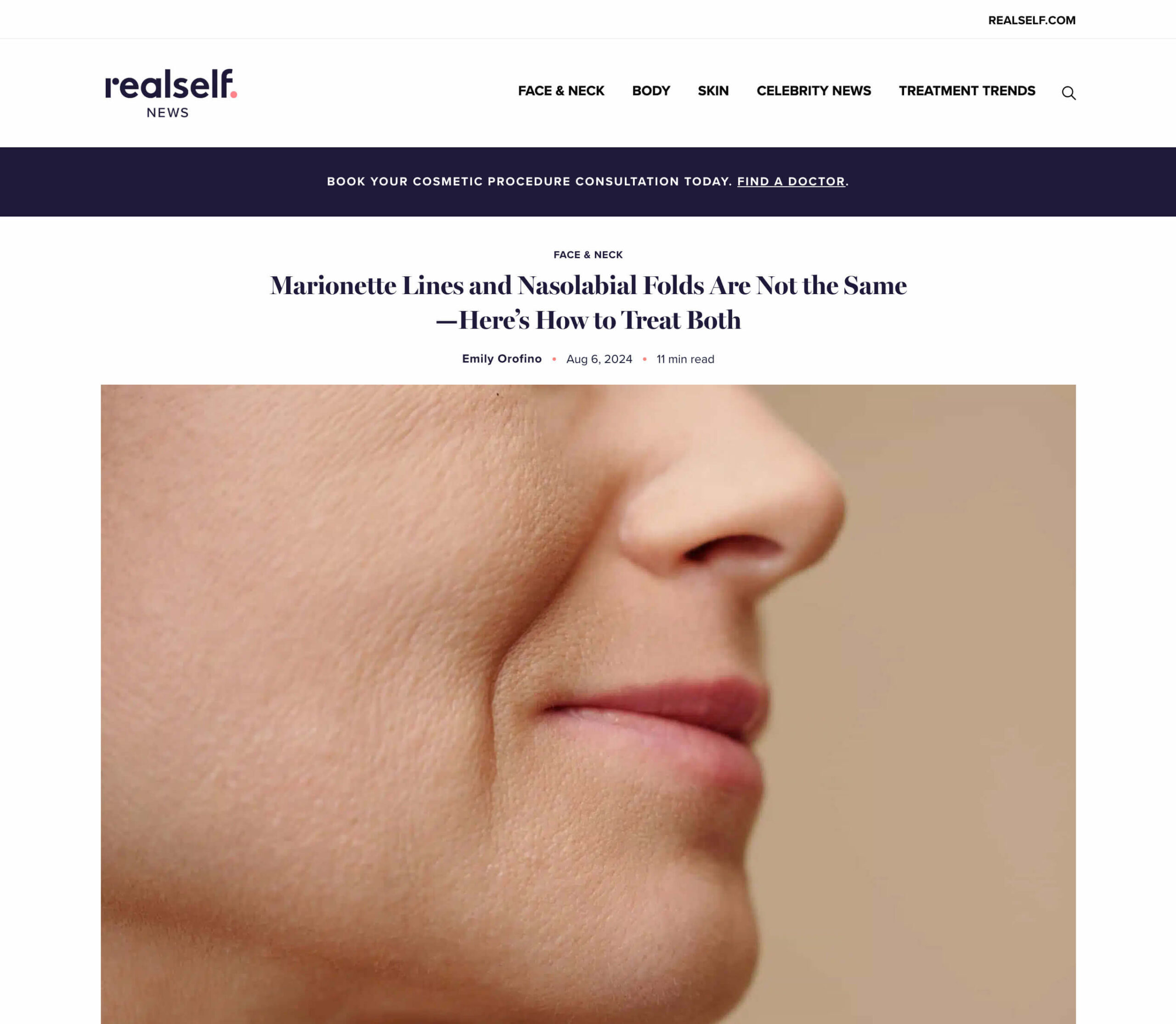 Article: Marionette Lines and Nasolabial Folds Are Not the Same—Here’s How to Treat Both