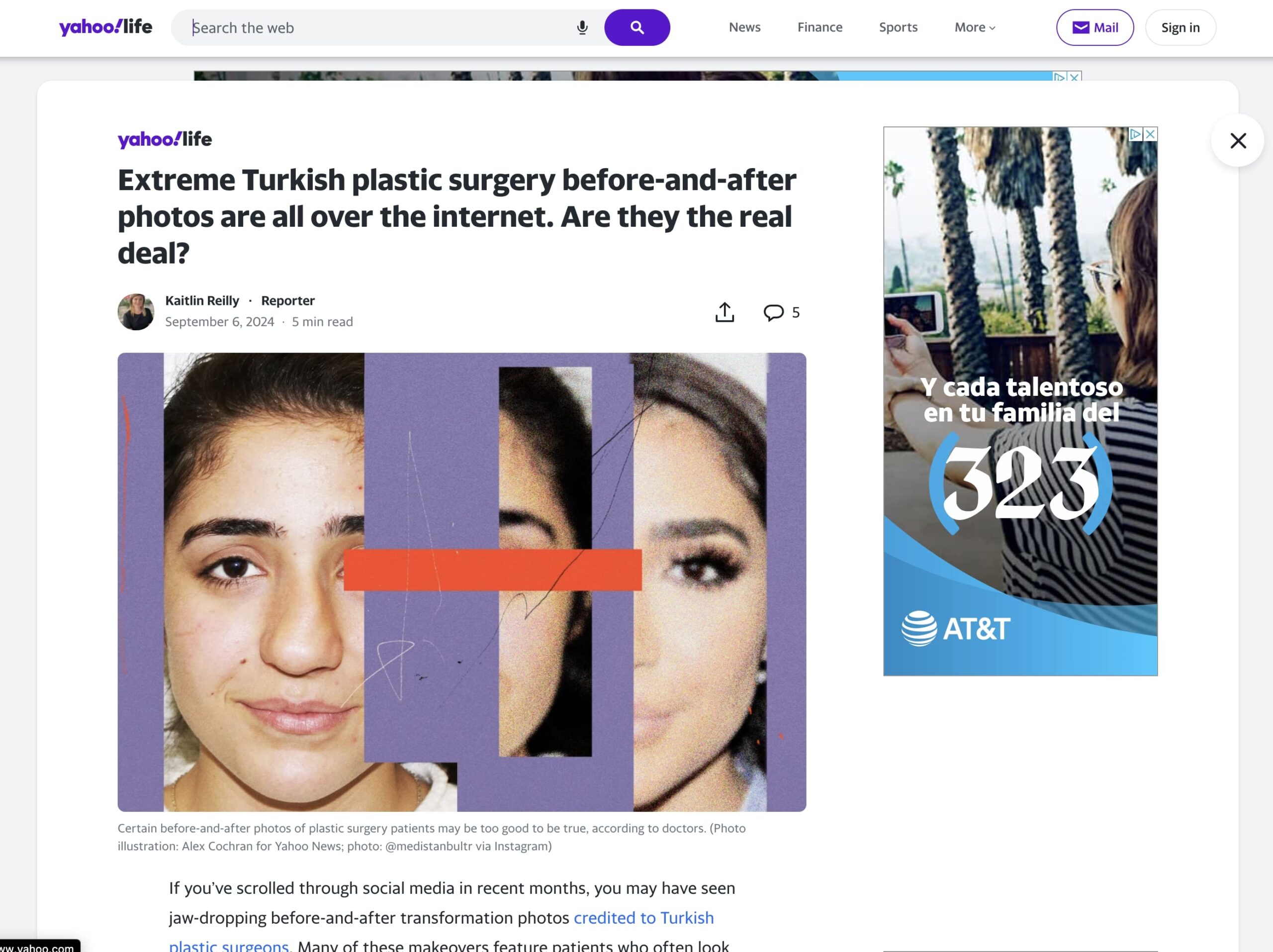 Article: Extreme Turkish plastic surgery before-and-after photos are all over the internet. Are they the real deal?