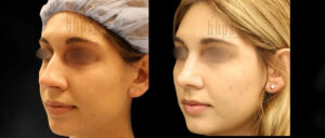 Rhinoplasty Patient 55 Before & After - Thumbnail