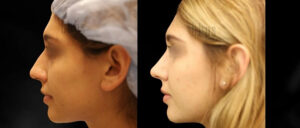 Rhinoplasty Patient 55 Before & After - Thumbnail