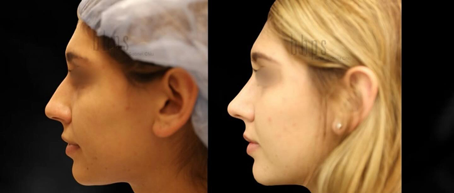 Rhinoplasty Patient 55 Before & After