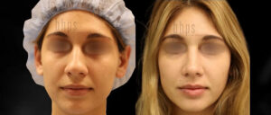 Rhinoplasty Patient 55 Before & After - Thumbnail