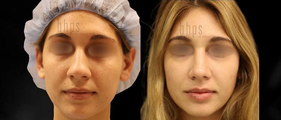 Rhinoplasty Patient 55 Before & After