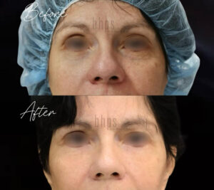 Blepharoplasty Patients 07 Before & After - Thumbnail