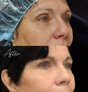 Blepharoplasty Patients 07 Before & After - Thumbnail