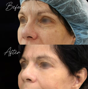 Blepharoplasty Patients 07 Before & After - Thumbnail