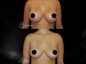 Breast Implant Removal Patient 01 Before & After - Thumbnail