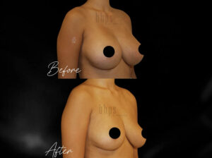 Breast Implant Removal Patient 01 Before & After - Thumbnail