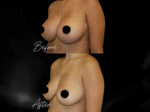 Breast Implant Removal Patient 01 Before & After - Thumbnail