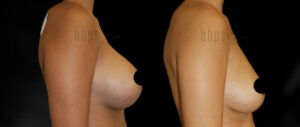 Breast Implant Removal Patient 01 Before & After - Thumbnail