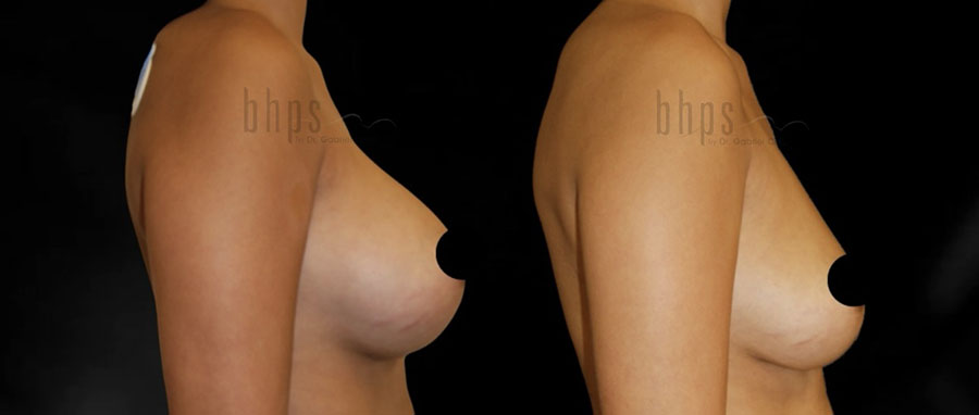 Breast Implant Removal Patient 01 Before & After