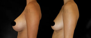 Breast Implant Removal Patient 01 Before & After - Thumbnail