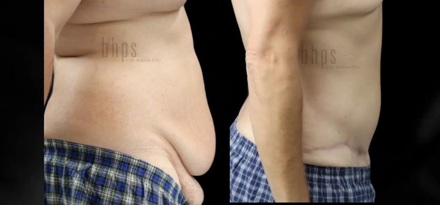 Tummy Tuck Patient 31 Before & After