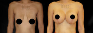 Breast Augmentation Patient 104 Before & After - Thumbnail