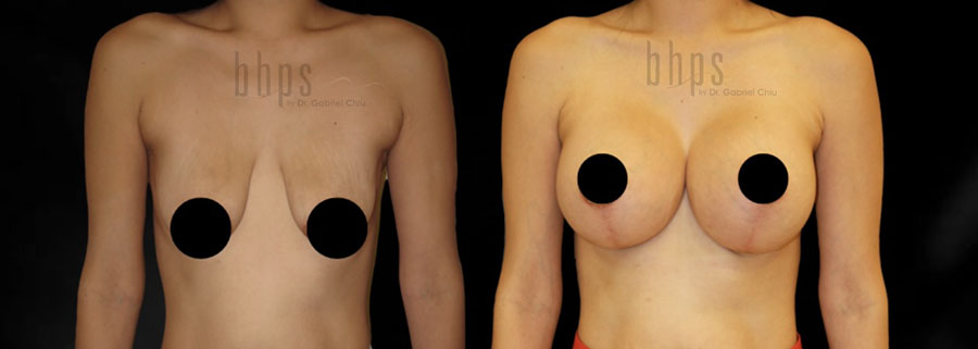 Breast Augmentation Patient 104 Before & After