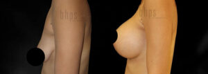 Breast Augmentation Patient 104 Before & After - Thumbnail