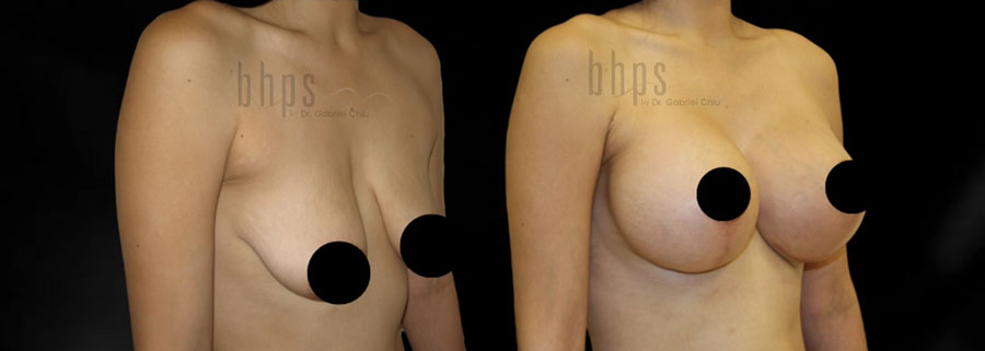 Breast Augmentation Patient 104 Before & After