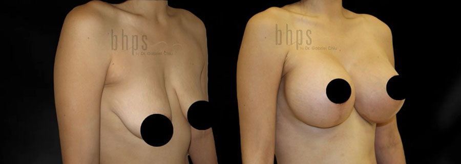 Breast Augmentation Patient 104 Before & After