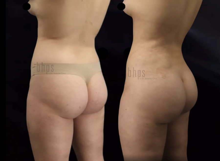 Brazilian Butt Lift Patient 37 Before & After