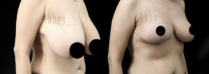 Breast Reduction Patient 03 Before & After - Thumbnail