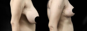 Breast Reduction Patient 03 Before & After - Thumbnail