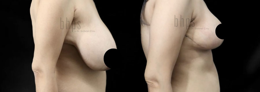 Breast Reduction Patient 03 Before & After