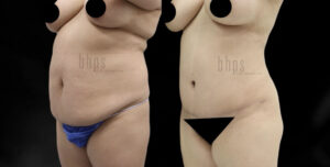 Tummy Tuck Patient 30 Before & After - Thumbnail