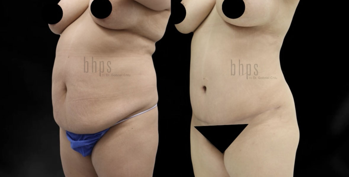 Tummy Tuck Patient 30 Before & After