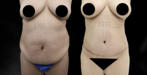 Tummy Tuck Patient 30 Before & After - Thumbnail