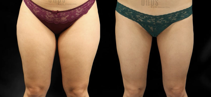 Liposuction Patient 59 Before & After