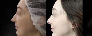 Chin Augmentation Patient 03 Before & After - Thumbnail