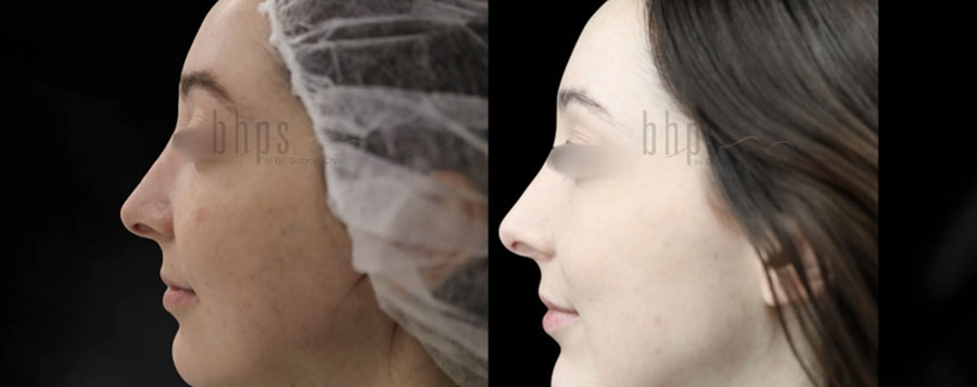 Chin Augmentation Patient 03 Before & After