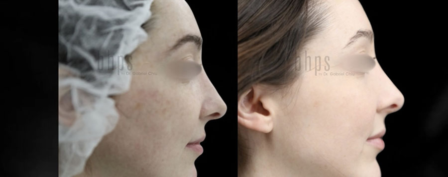 Chin Augmentation Patient 03 Before & After