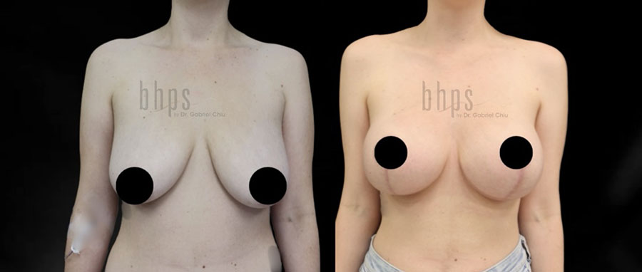 Breast Lift Patient 13 Before & After