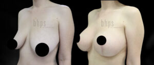 Breast Lift Patient 13 Before & After - Thumbnail