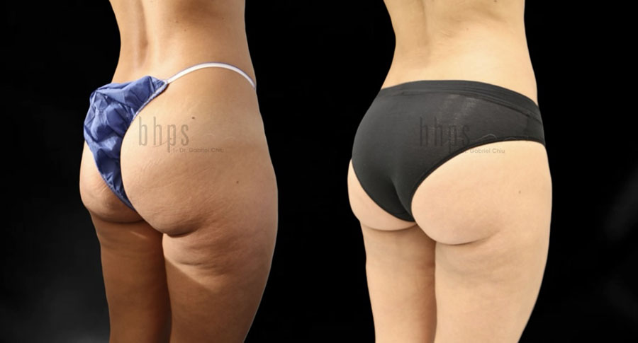 Brazilian Butt Lift Patient 38 Before & After