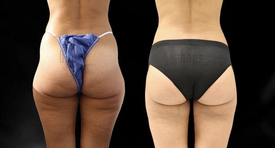 Brazilian Butt Lift Patient 38 Before & After