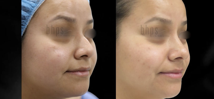 Rhinoplasty Patient 47 Before & After