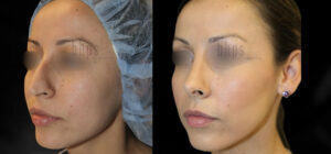 Rhinoplasty Patient 48 Before & After - Thumbnail