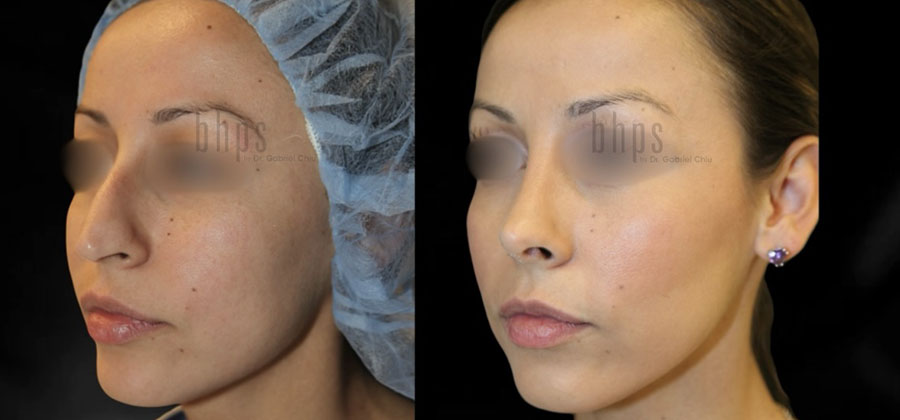 Rhinoplasty Patient 48 Before & After